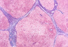 Breakthrough Designation for Liver Disease Therapy